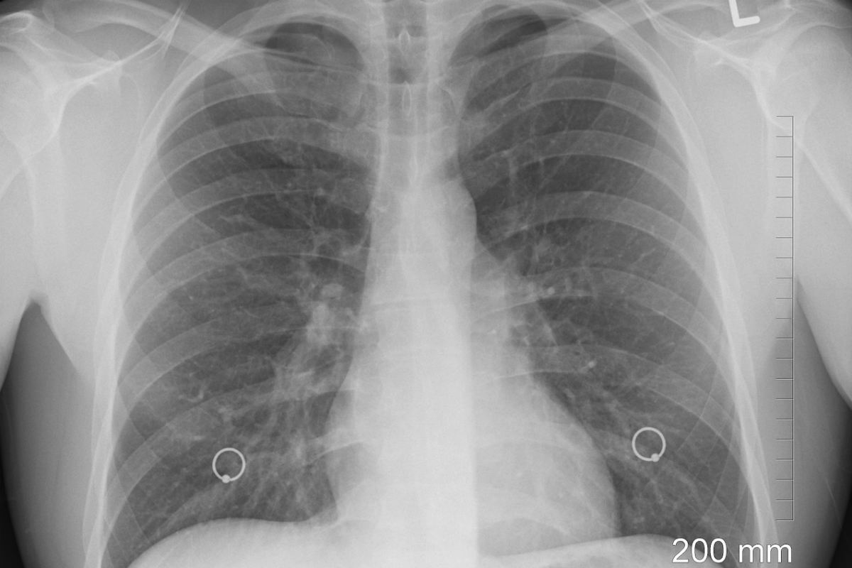 ¿Qué pasa en los pulmones con Covid-19?. Noticias en tiempo real