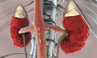 Enfermedad Renal Crónica.