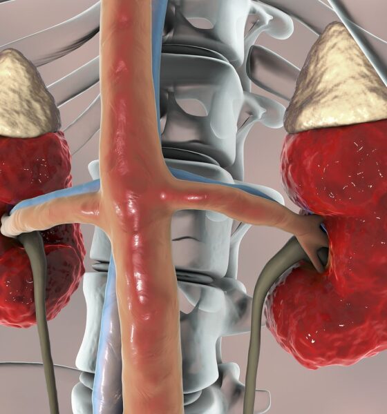 Enfermedad Renal Crónica.
