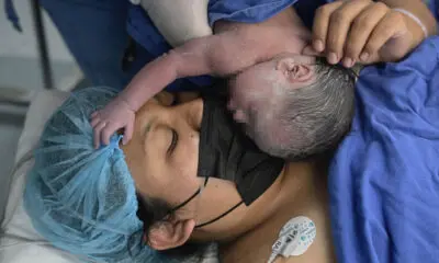 Células madre del cordón umbilical abren capítulo en atención pediátrica mexicana