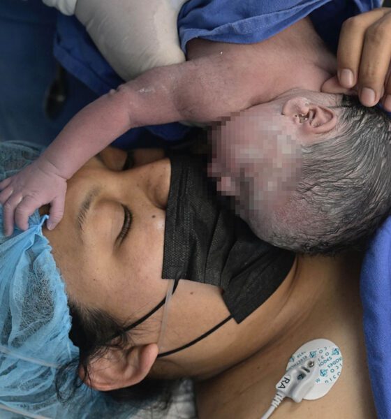 Células madre del cordón umbilical abren capítulo en atención pediátrica mexicana